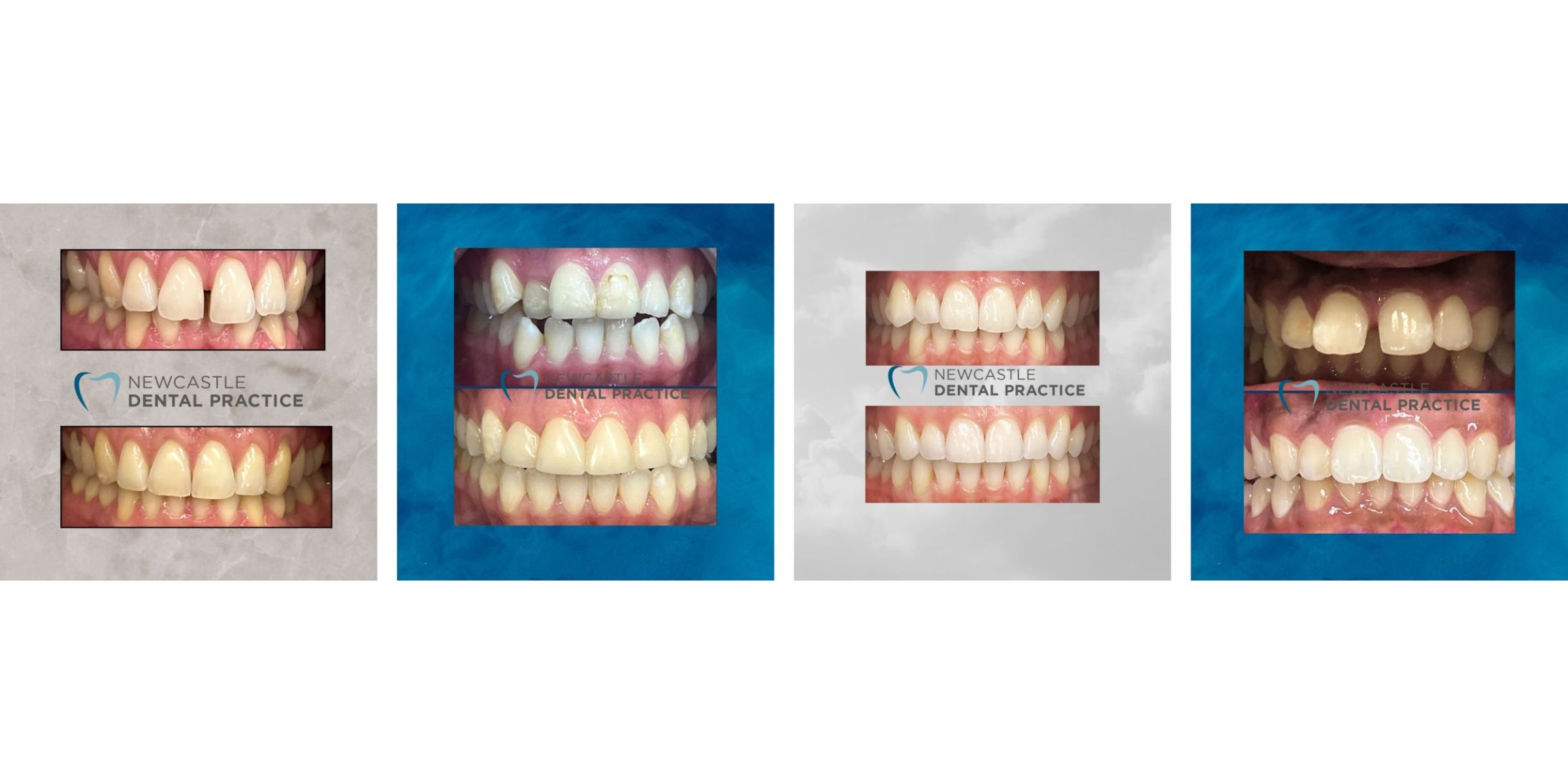 teeth whitening